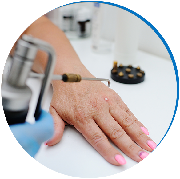 wart-removal