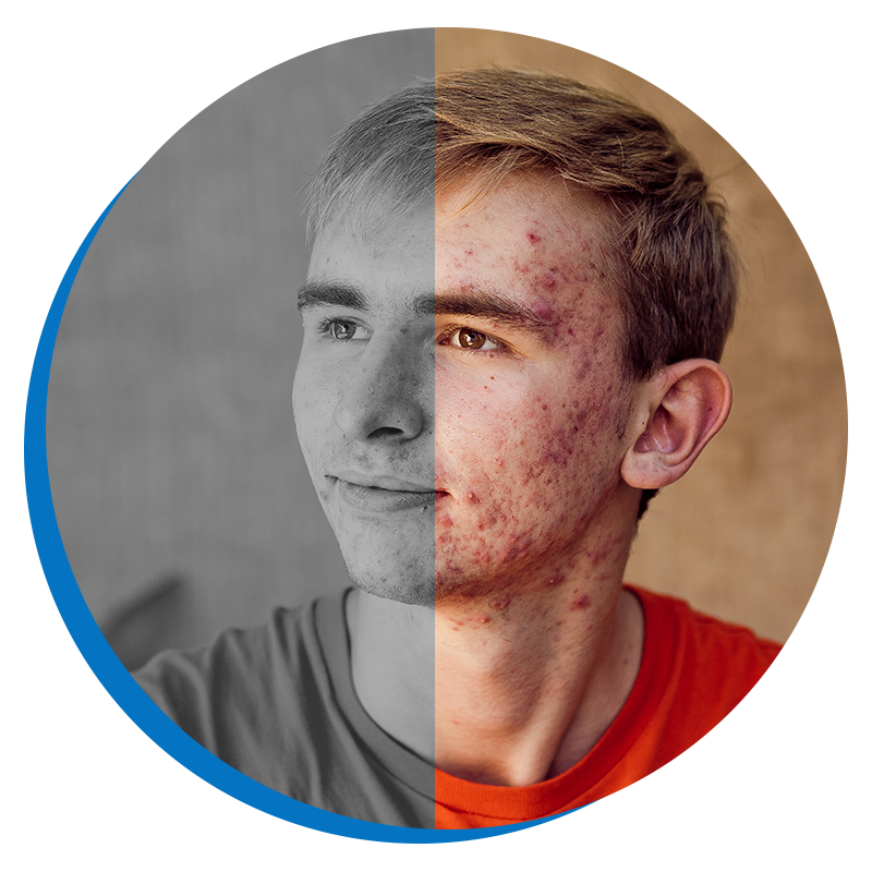 Acne Treatment PB - img 2