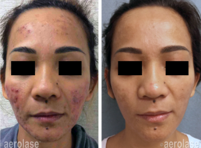 Courtesy-of-aerolase