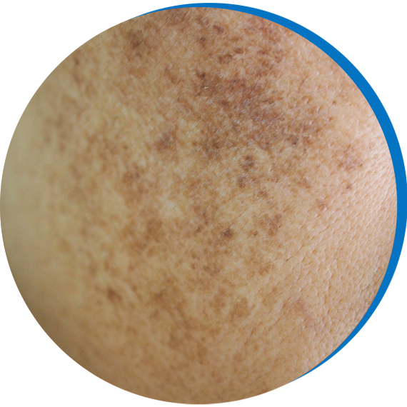 What is Melasma_
