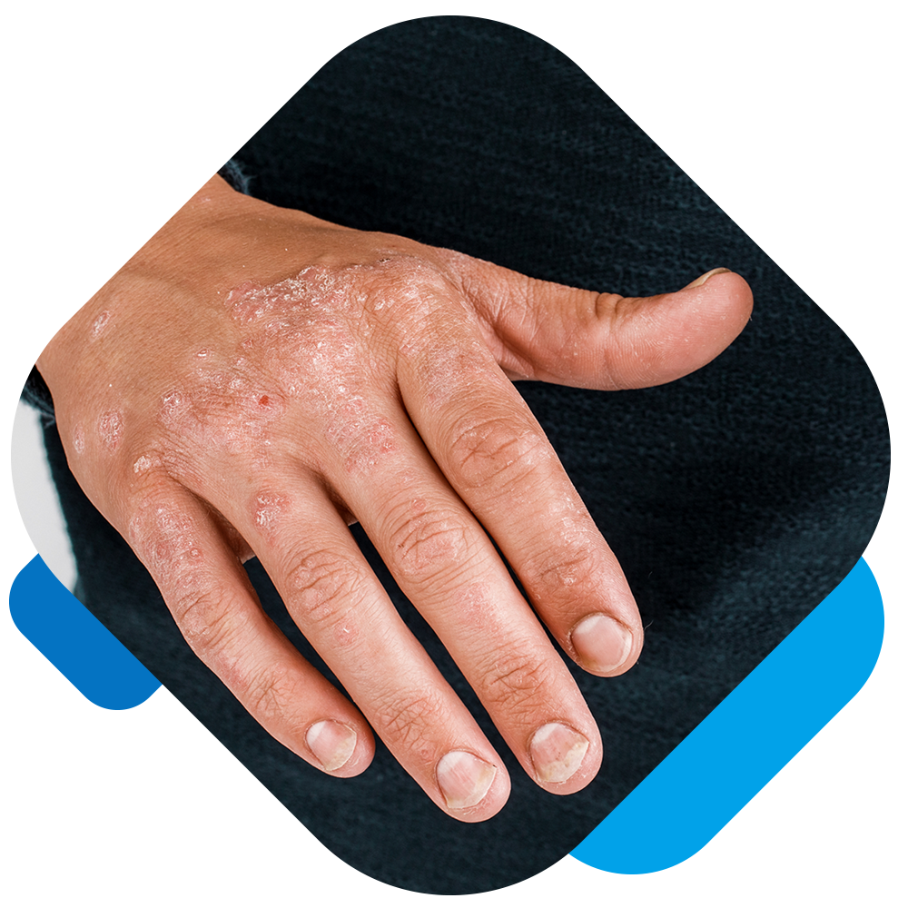 Eczema PB - img 1