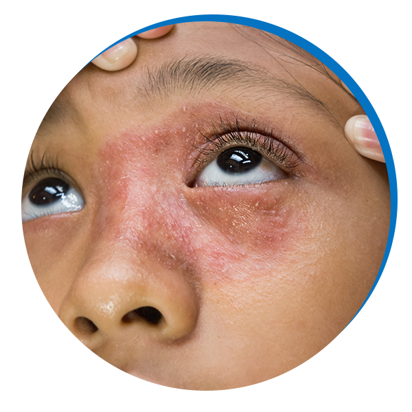 Girl with rosacea