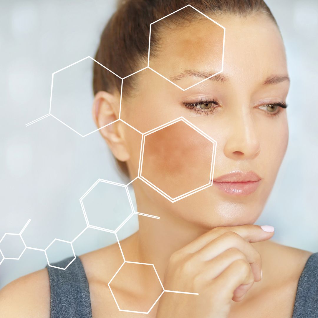 Melasma - What You Need To Know