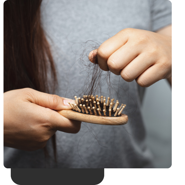 Alopecia Areata