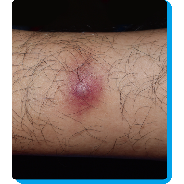 skin boil
