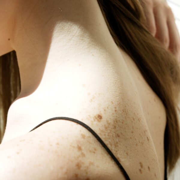 freckles on shoulders