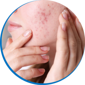 acne on cheek